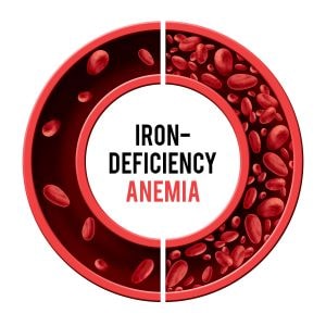 iron deficiency anemia
